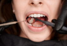 Understanding When Local Evaluation May Lead to Wisdom Teeth Removal